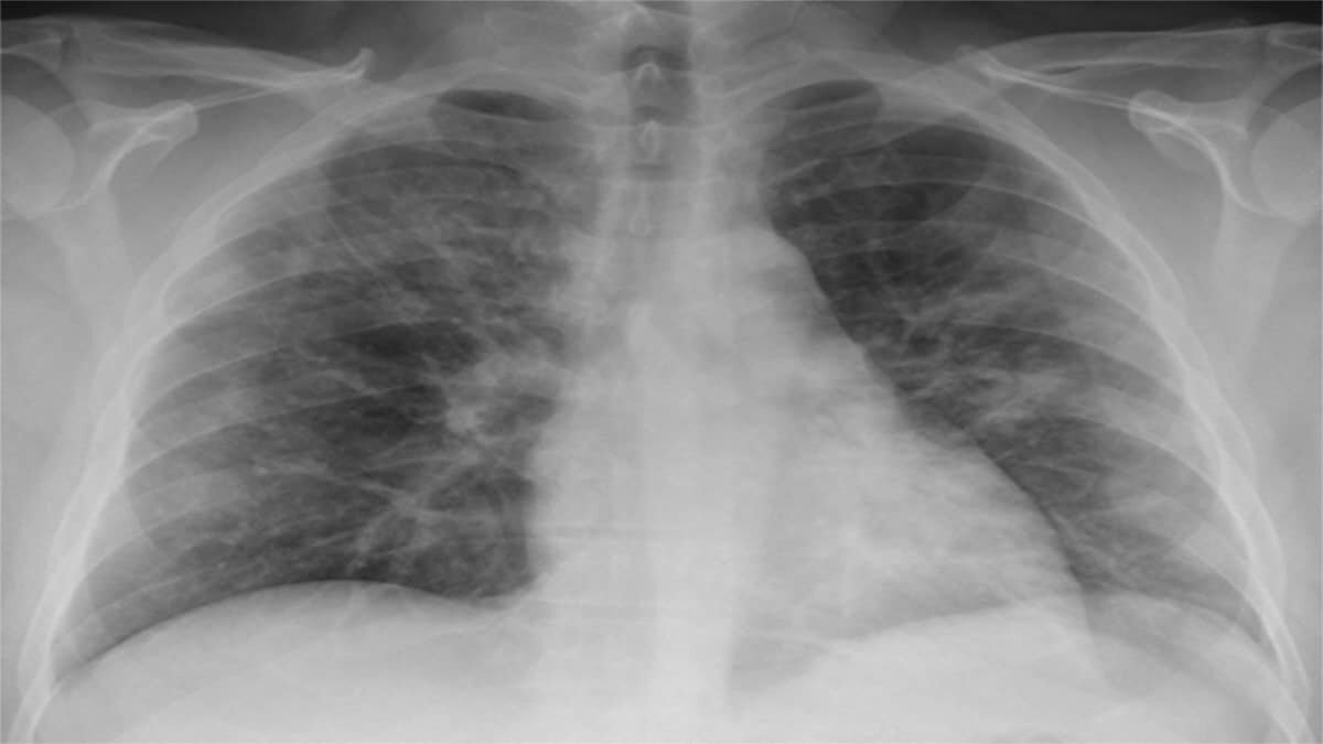 Especialistas recomendaron rehabilitación pulmonar inmediata tras padecer Covid-19.