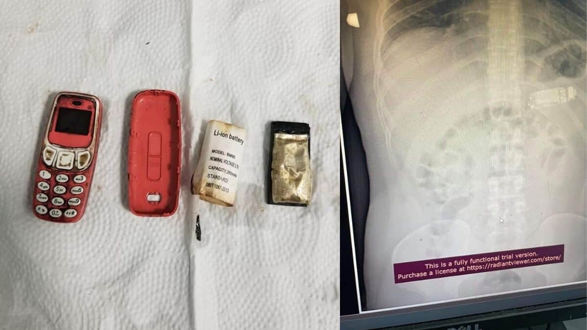 Médicos salvan a hombre al sacarle celular del estómago