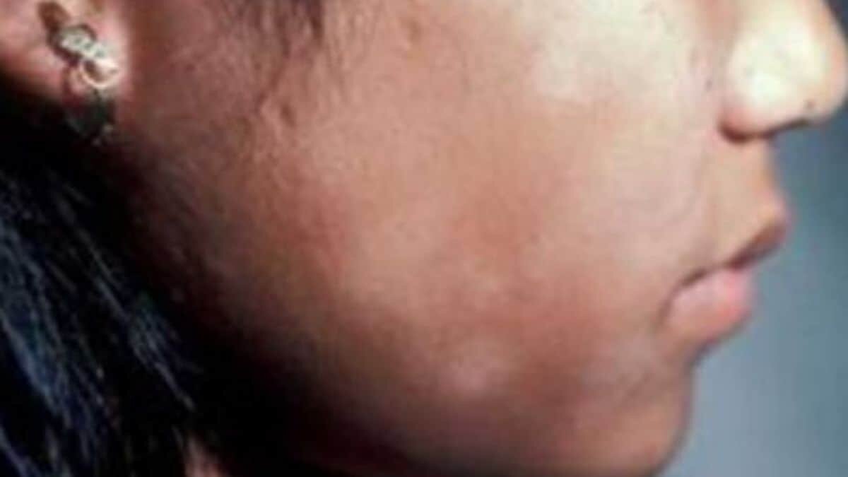 Así podrás quitar los jiotes de tu rostro
