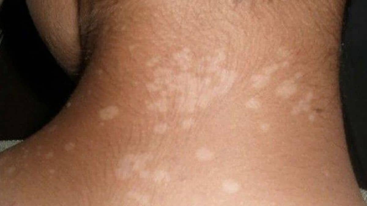 Así podrás quitar los jiotes de tu rostro