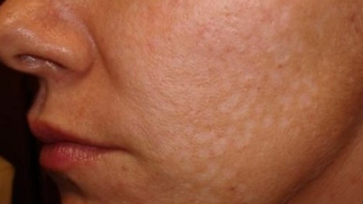 Así podrás quitar los jiotes de tu rostro