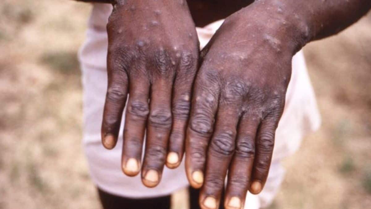 Confirman más de 200 casos de viruela del mono