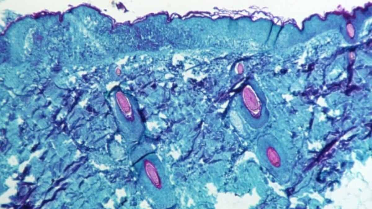 Confirman más de 200 casos de viruela del mono