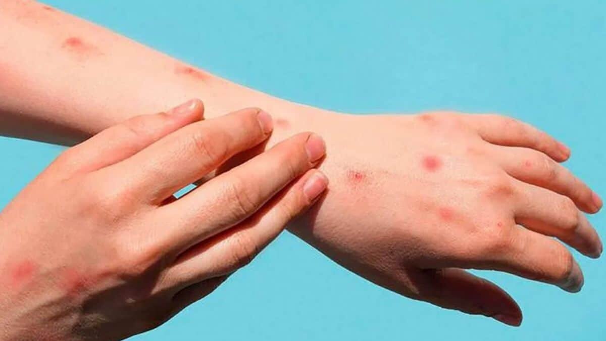 Detectan a turista con viruela del mono en Jalisco y escapa